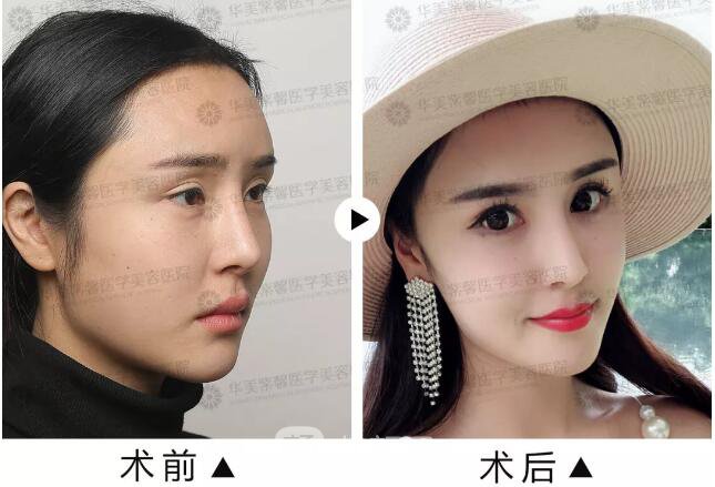 華美紫馨雙眼皮失敗修復(fù)圖純分享案例