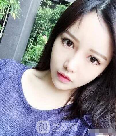 艾紅梅面部自體脂肪填充手術(shù)圖心情分享