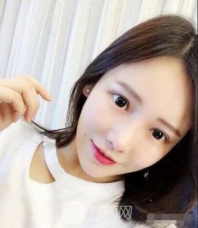 艾紅梅面部自體脂肪填充手術(shù)圖心情分享