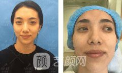 肖瑋玻尿酸填充太陽(yáng)穴果圖+注射照片分享~