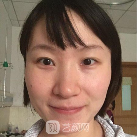 中日友好醫(yī)院高占巍磨下頜角案例分享~