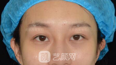 北京西美整形全切雙眼皮，徹底拯救我的大小眼