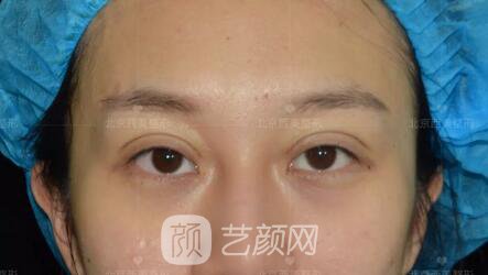 北京西美整形全切雙眼皮，徹底拯救我的大小眼