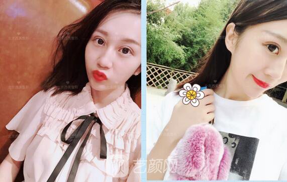 北京西美整形全切雙眼皮，徹底拯救我的大小眼