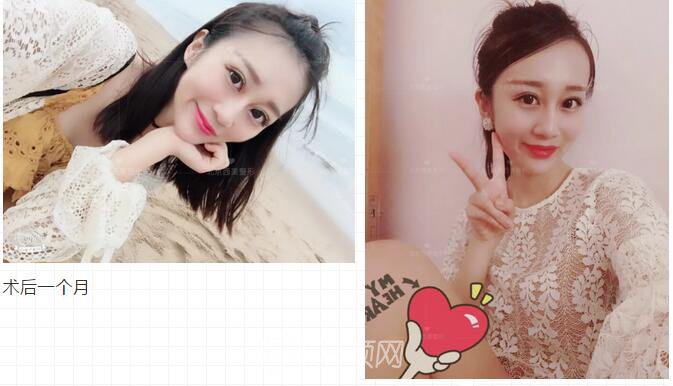 北京西美整形全切雙眼皮，徹底拯救我的大小眼