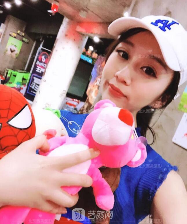 北京西美整形全切雙眼皮，徹底拯救我的大小眼
