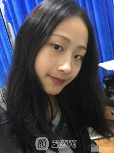 萍鄉(xiāng)優(yōu)美整形李清芳全切雙眼皮照片 拯救眼睛不對(duì)稱