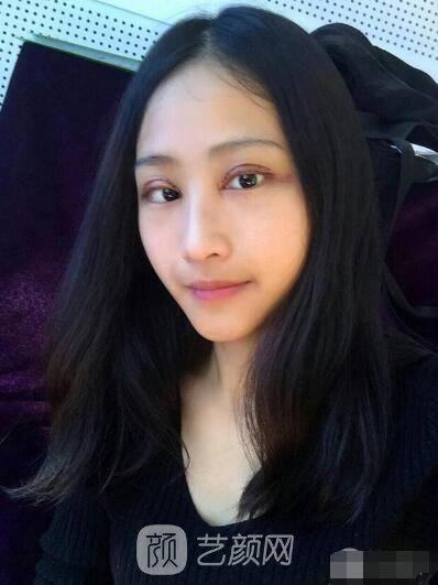 萍鄉(xiāng)優(yōu)美整形李清芳全切雙眼皮照片 拯救眼睛不對(duì)稱