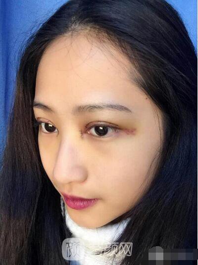 萍鄉(xiāng)優(yōu)美整形李清芳全切雙眼皮照片 拯救眼睛不對(duì)稱