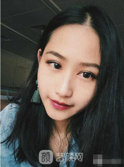 萍鄉(xiāng)優(yōu)美整形李清芳全切雙眼皮照片 拯救眼睛不對(duì)稱