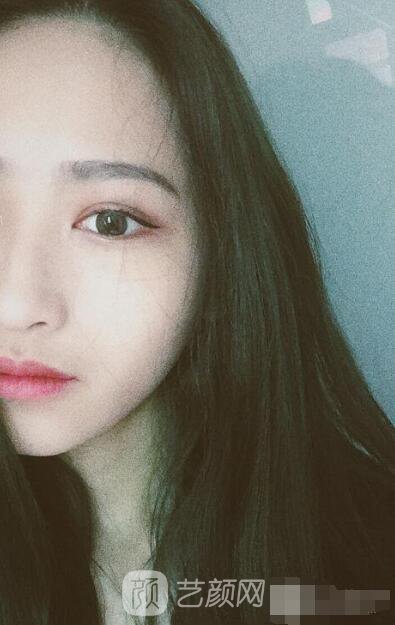 萍鄉(xiāng)優(yōu)美整形李清芳全切雙眼皮照片 拯救眼睛不對(duì)稱