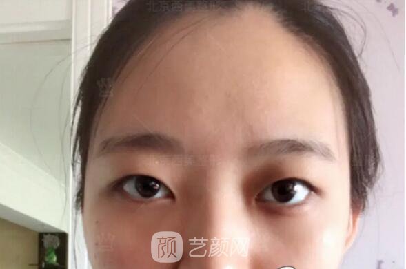 北京西美整形醫(yī)院全切雙眼皮真人案例圖|內(nèi)附恢復(fù)過(guò)程哦~