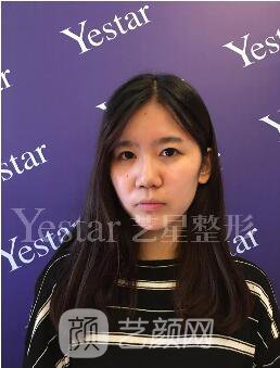 南京藝星割雙眼皮案例半年圖