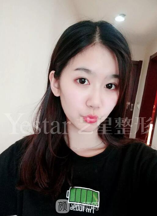 南京藝星割雙眼皮案例半年圖