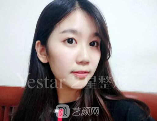 南京藝星割雙眼皮案例半年圖