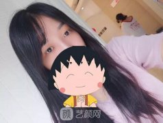 成都嬌點姜宇祿雙眼皮修復(fù)案例，重獲新生！