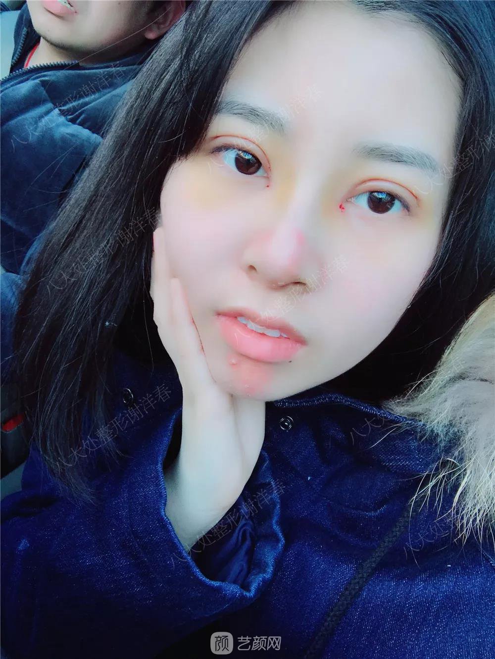 北京八大處割雙眼皮恢復(fù)過(guò)程，內(nèi)附圖