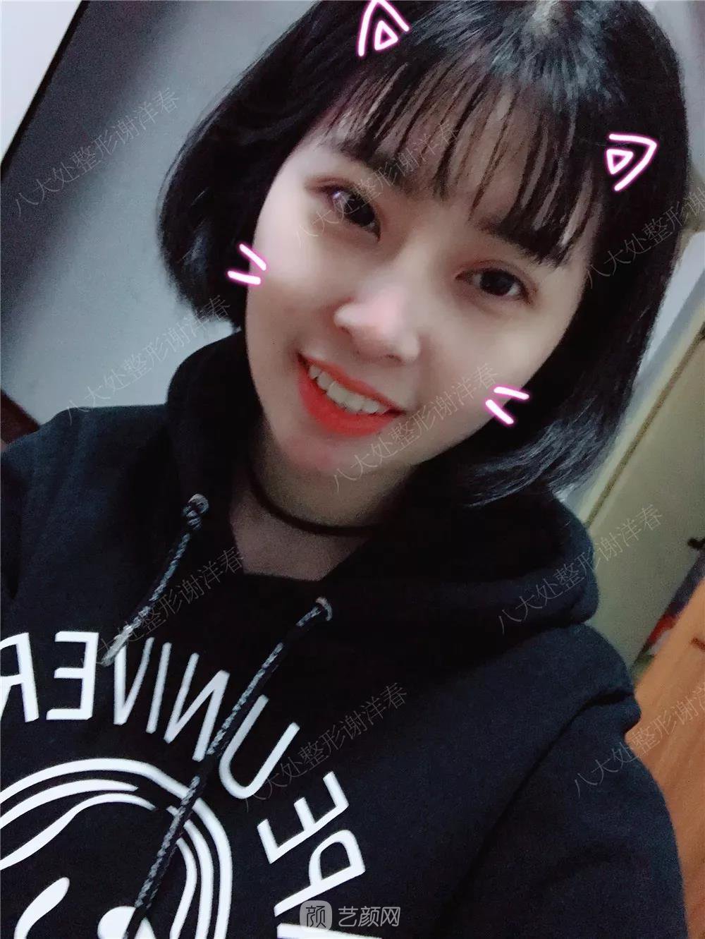 北京八大處割雙眼皮恢復(fù)過(guò)程，內(nèi)附圖