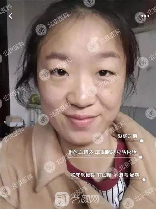 北京八大處整形布仁全切雙眼皮真實(shí)案例|圖
