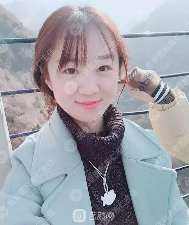 北京八大處整形布仁全切雙眼皮真實(shí)案例|圖