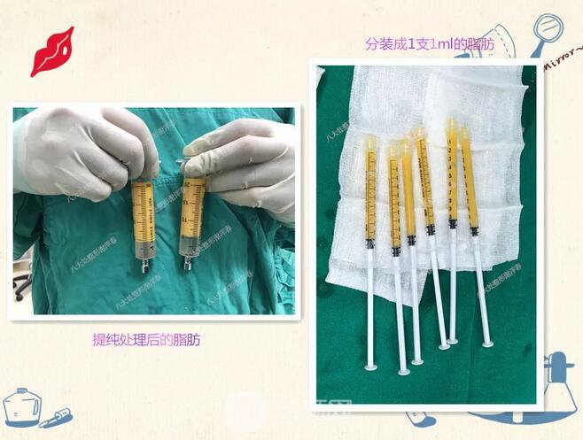 北京八大處面部脂肪填充心形臉真實(shí)案例|照片