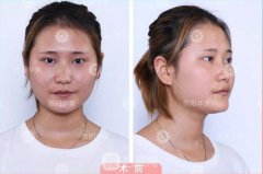 泉州西華謝占軍割雙眼皮+隆鼻真人案例圖分享