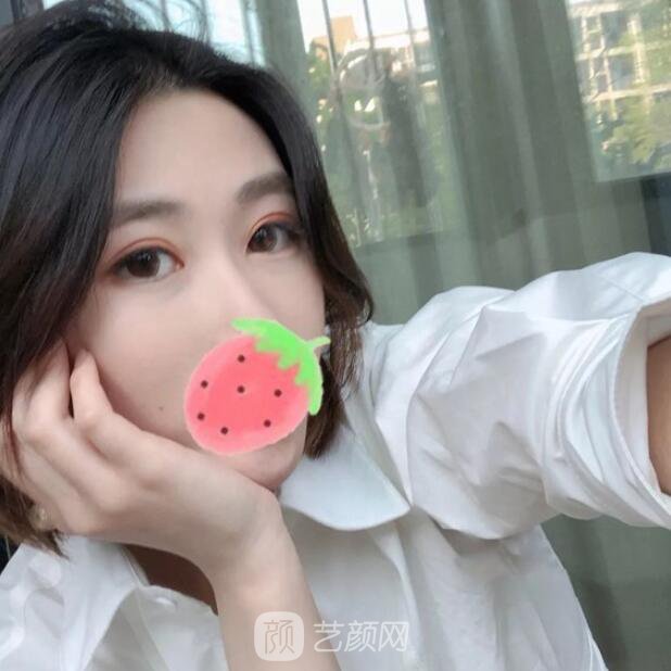 東莞美立方單眼皮割雙眼皮圖|內(nèi)附手術(shù)全程恢復(fù)