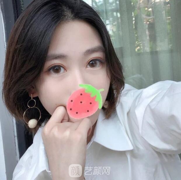 東莞美立方單眼皮割雙眼皮圖|內(nèi)附手術(shù)全程恢復(fù)