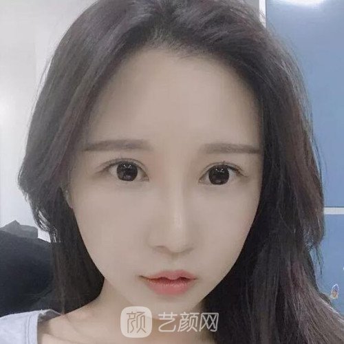 成都銅雀臺(tái)雷剛雙眼皮修復(fù)案例分享，半個(gè)月果圖~