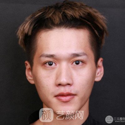 重慶軍美胡金香鼻部手術(shù)六個(gè)月了，分享恢復(fù)果~