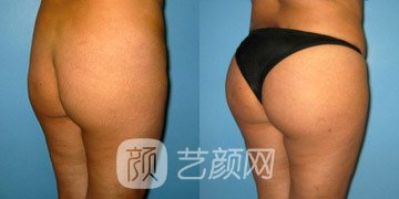 巴西提臀術(shù)價(jià)格多少？巴西提臀術(shù)價(jià)格影響因素 