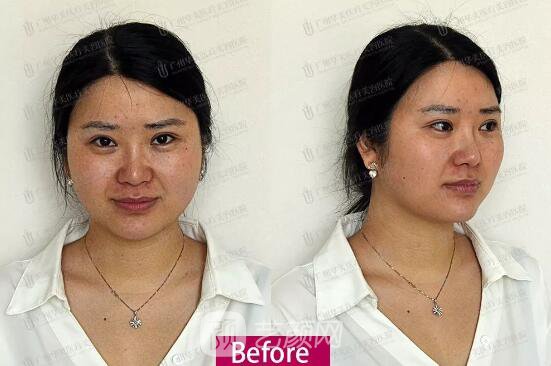 皮-秒激光祛斑案例，恢復(fù)照片分享~