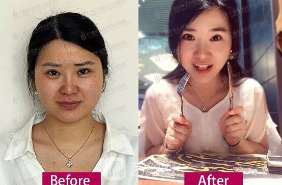 皮-秒激光祛斑案例，恢復(fù)照片分享~