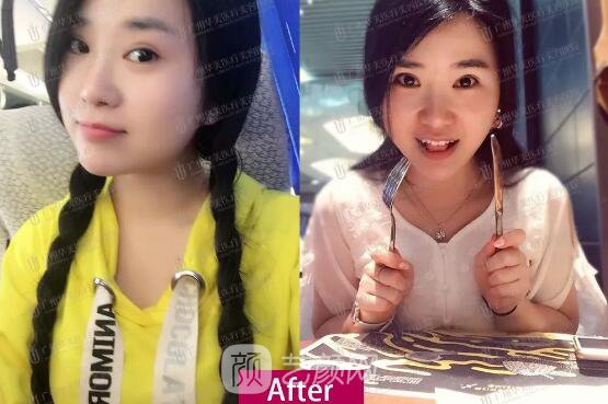 皮-秒激光祛斑案例，恢復(fù)照片分享~