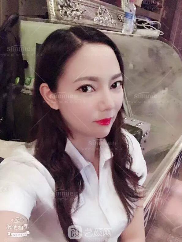 上海喜美全肋鼻修復(fù)+鼻頭縮小+鼻小柱后縮矯正案例~