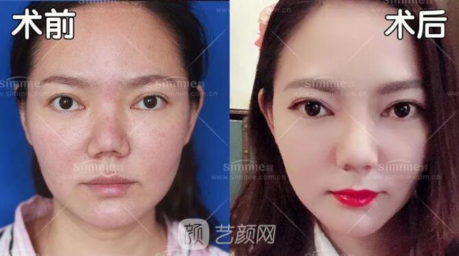 上海喜美全肋鼻修復(fù)+鼻頭縮小+鼻小柱后縮矯正案例~