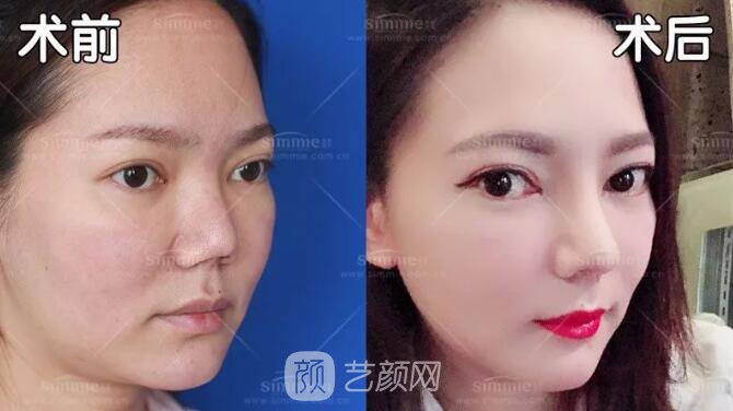 上海喜美全肋鼻修復(fù)+鼻頭縮小+鼻小柱后縮矯正案例~