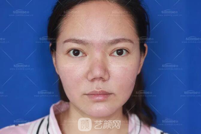 上海喜美全肋鼻修復(fù)+鼻頭縮小+鼻小柱后縮矯正案例~