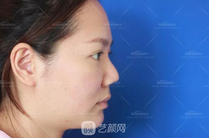 上海喜美全肋鼻修復(fù)+鼻頭縮小+鼻小柱后縮矯正案例~