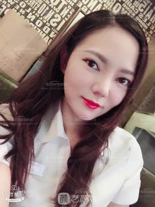 上海喜美全肋鼻修復(fù)+鼻頭縮小+鼻小柱后縮矯正案例~