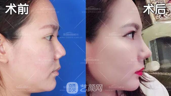 上海喜美全肋鼻修復(fù)+鼻頭縮小+鼻小柱后縮矯正案例~