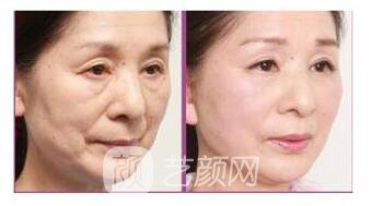 生物除皺價格多少?生物除皺價格影響因素~