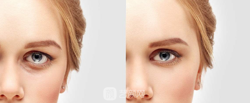 激光祛眼袋價格貴嗎？大概需要多少錢？