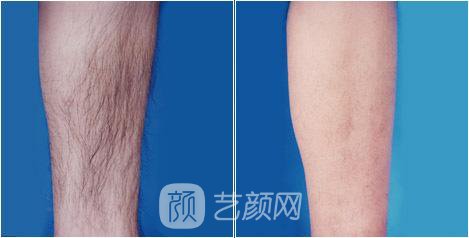 溫州激光脫毛一般要多少錢?