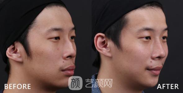 武漢駝峰鼻矯正費(fèi)用大概多少？