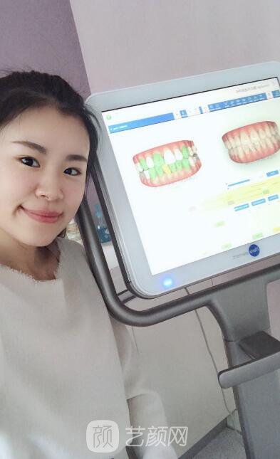 牙齒隱形矯正案例