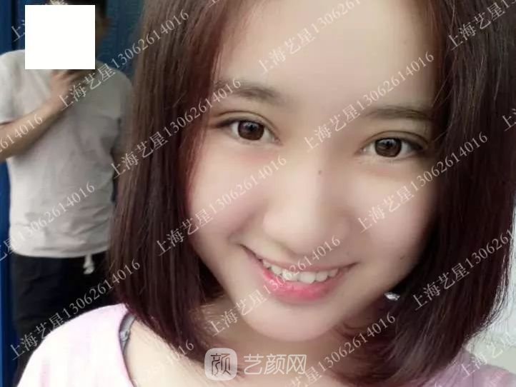 上海藝星割雙眼皮術后一個月恢復日記一則~