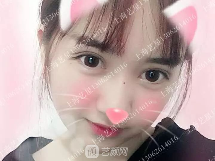 上海藝星割雙眼皮術后一個月恢復日記一則~