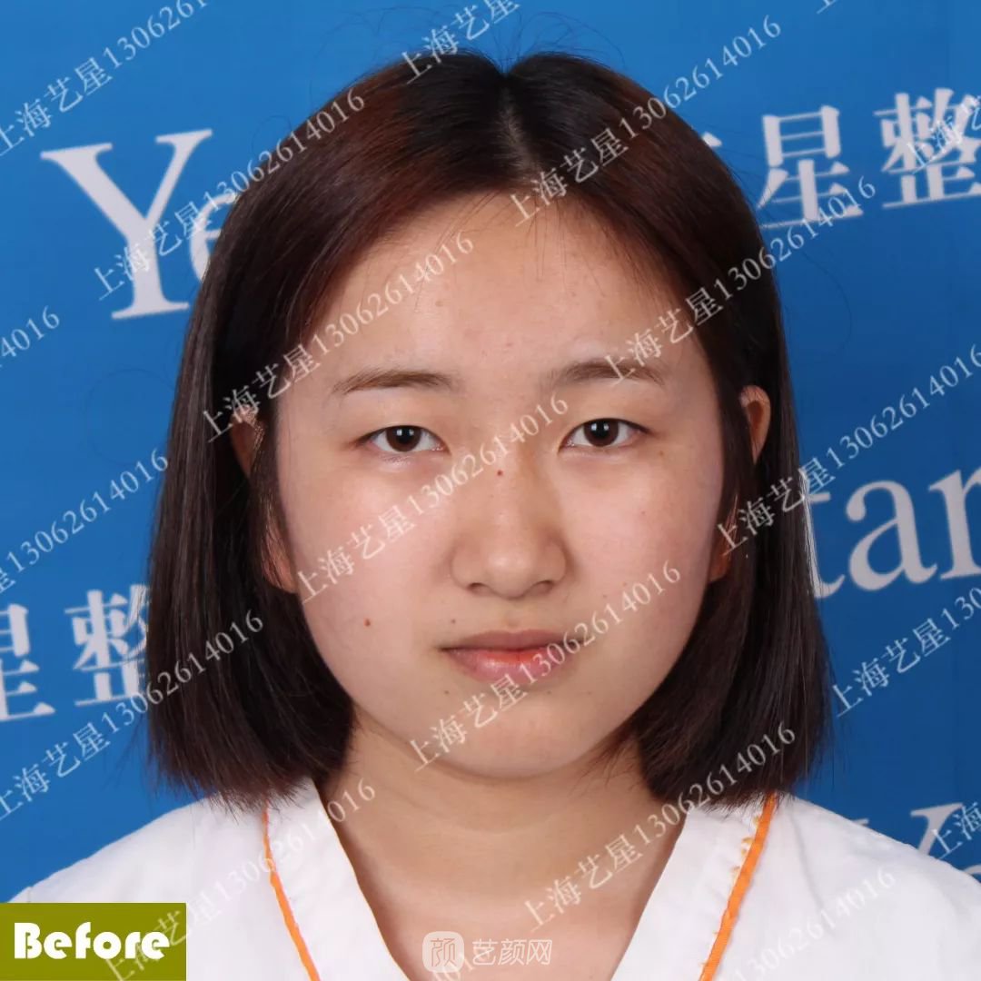 上海藝星割雙眼皮術后一個月恢復日記一則~