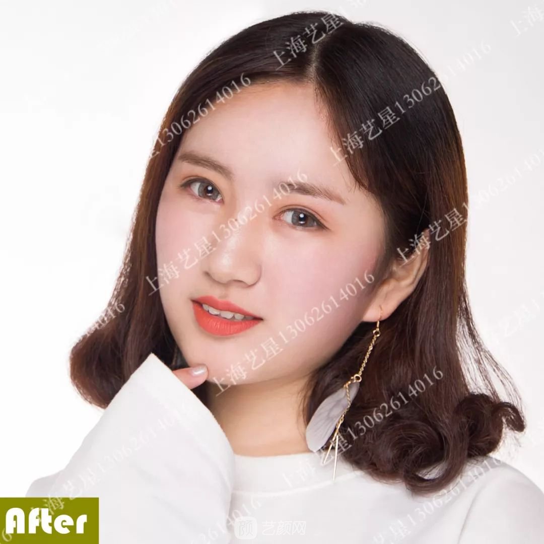 上海藝星割雙眼皮術后一個月恢復日記一則~